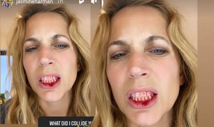 A Place In The Sun presenter Jasmine Harman shares pic of bloody lip injury after accident | Celebrity News | Showbiz & TV