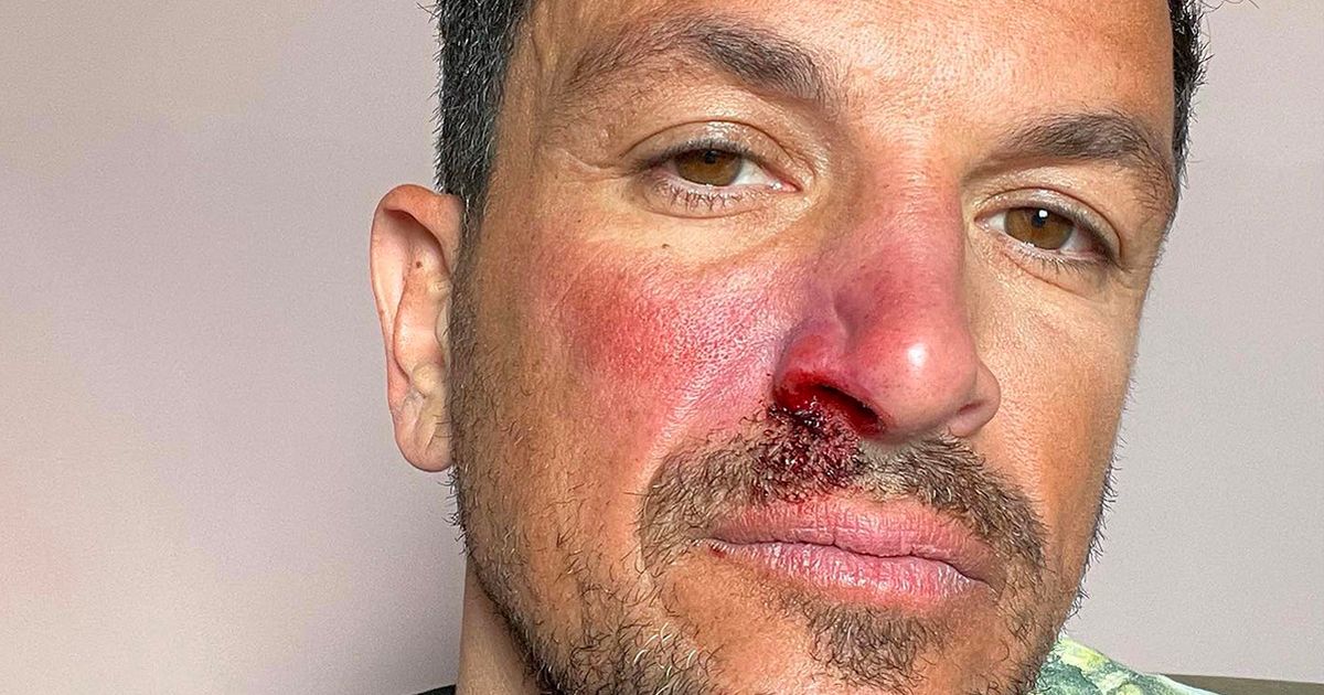 Peter Andre worries fans with snap of bloody nose – but not all is as it seems