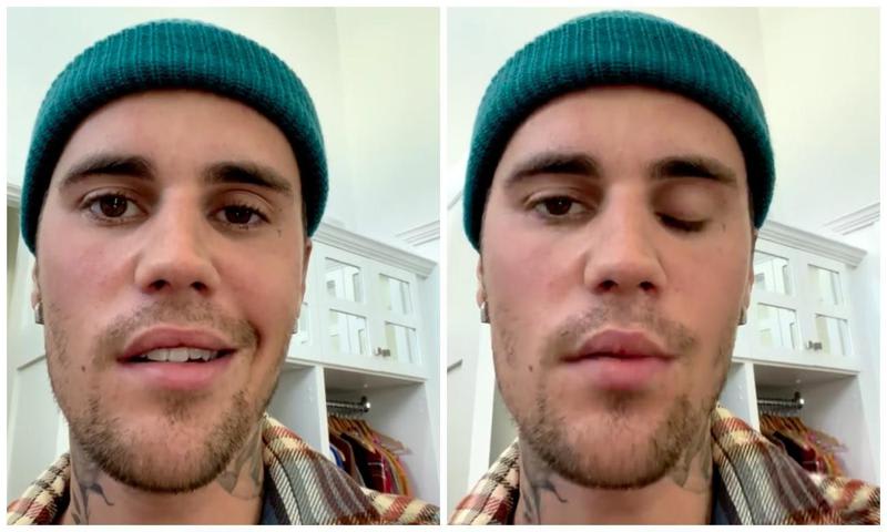 Justin Bieber’s face is partially paralyzed