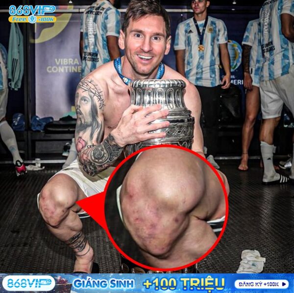 Đừng quên Messi đã giành chức vô địch Copa với chiếc đầu gối bầm tím và cái gót chân ch.ảy đ.ầ.y m.á.u ?