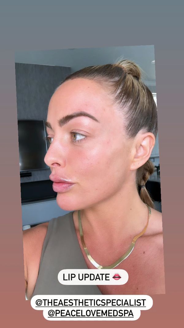 #MandyRose provides an update on her lips! ????